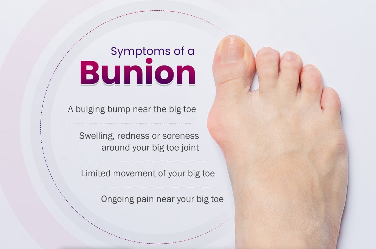 Bunions: Symptoms, Causes, & Treatment