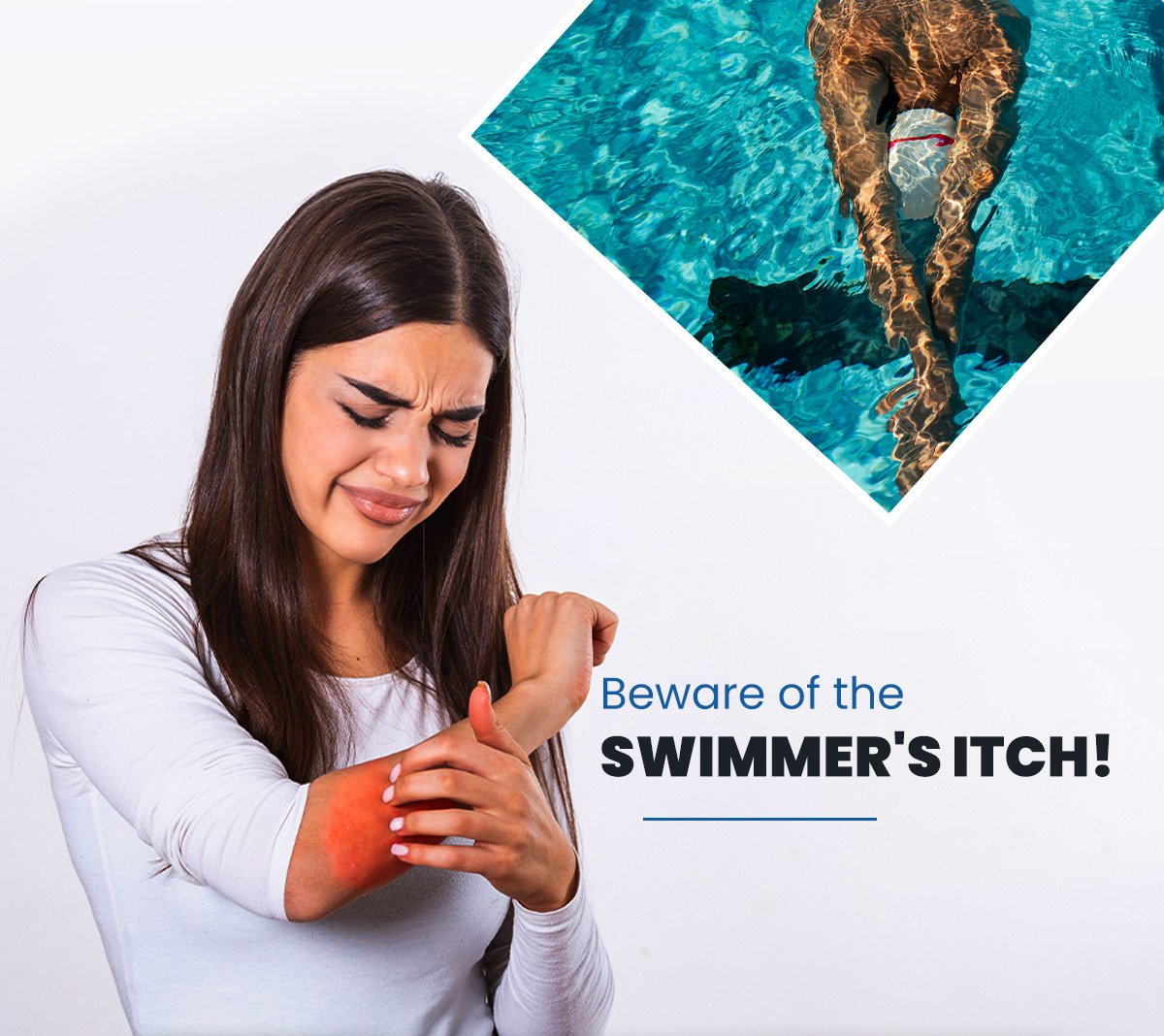 Beware Of Swimmers Itch 