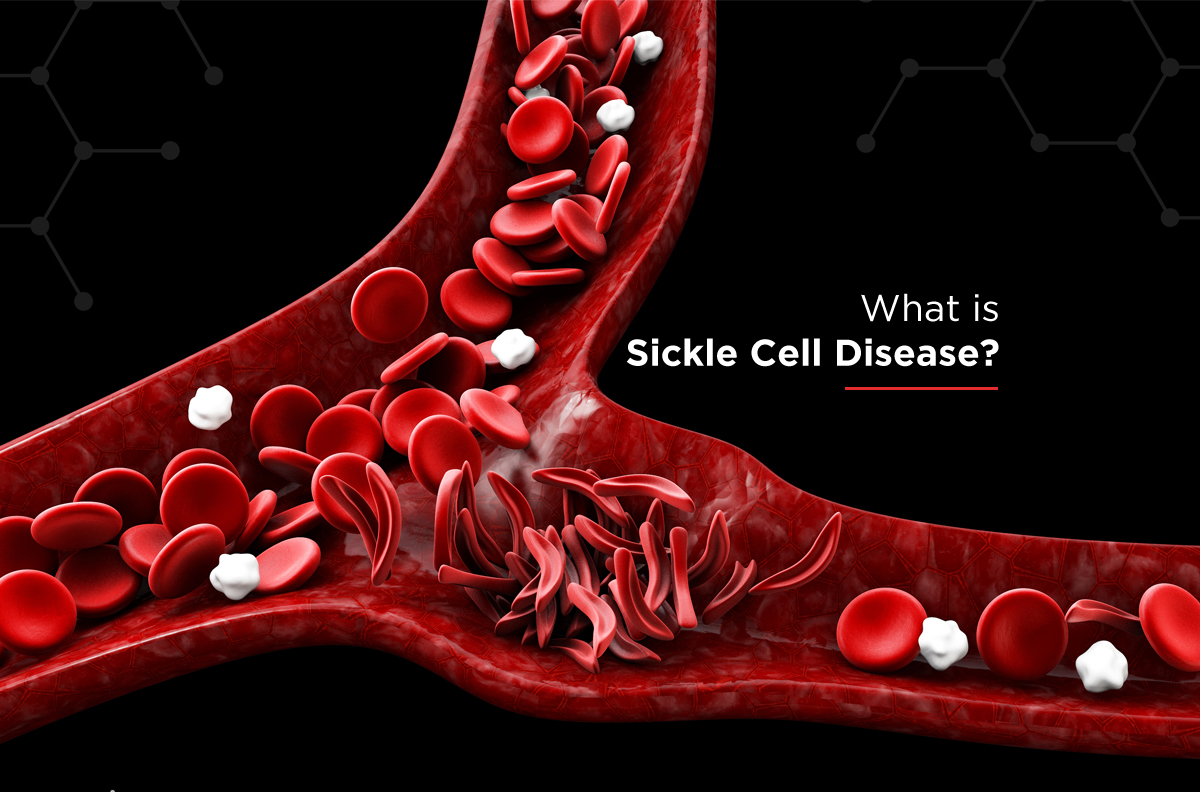 What Is Sickle Cell Disease