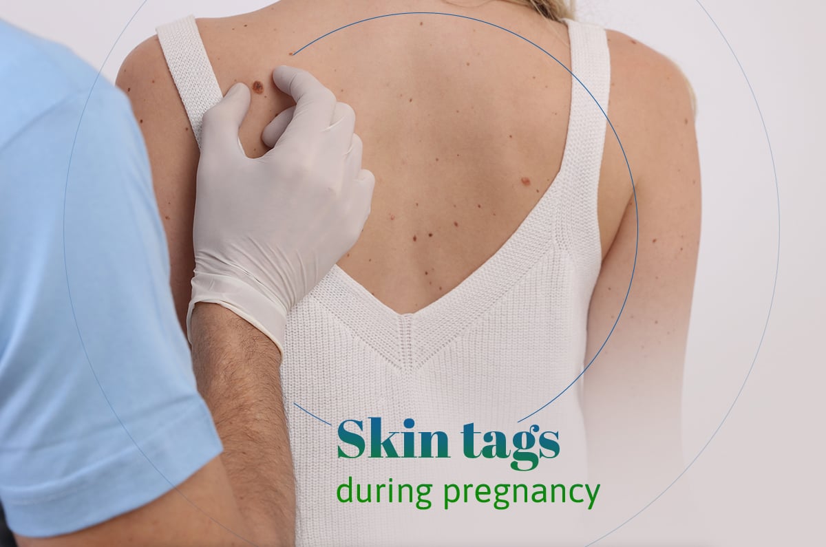 Skin Tags During Pregnancy