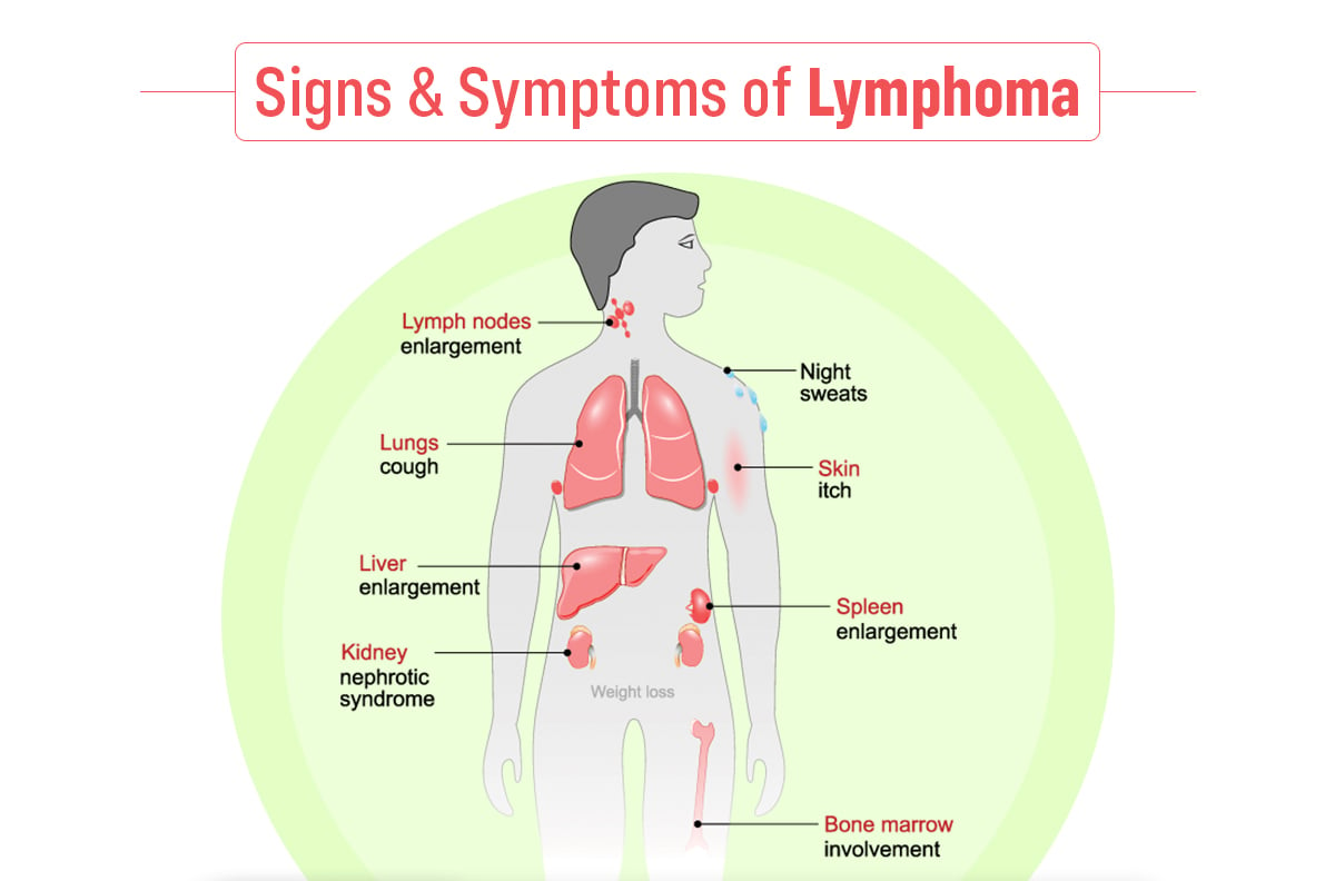 Lymphoma: Symptoms, Causes, And Treatments, 52% OFF