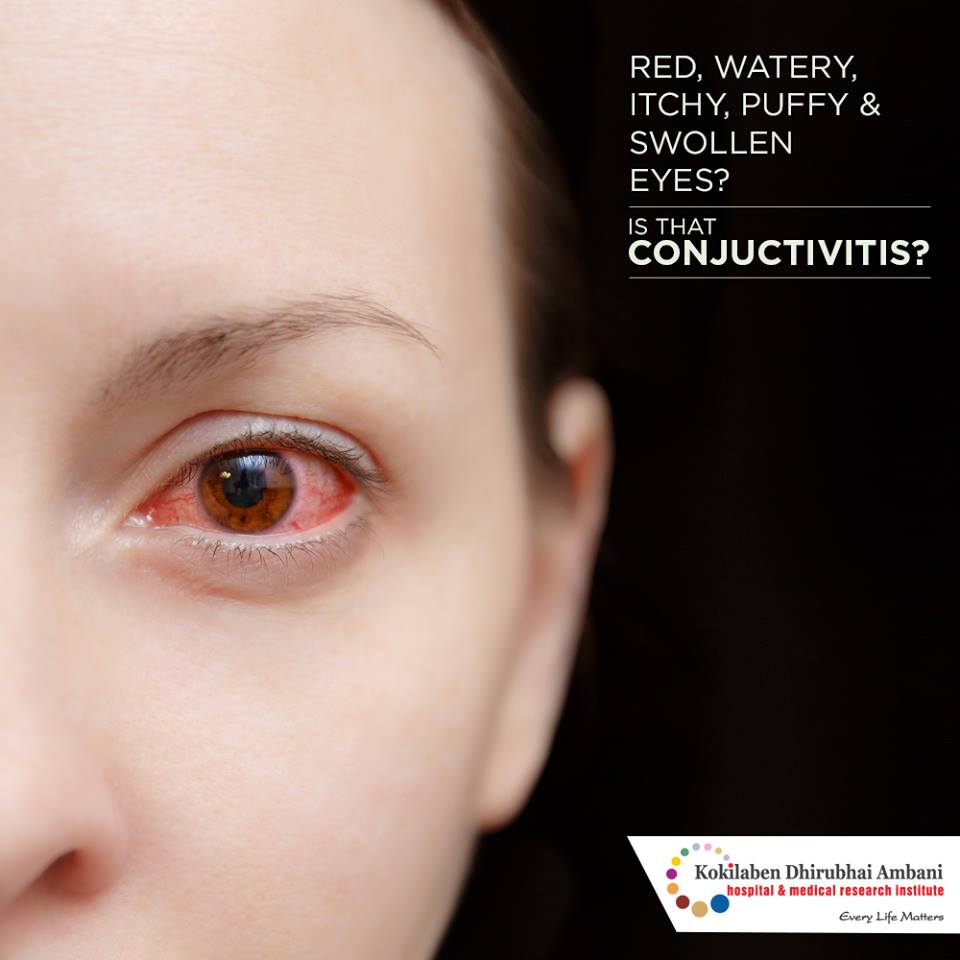 Are your eyes red, watery, itchy, puffy and swollen? Health Tips from