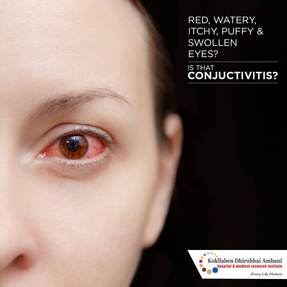 are-your-eyes-red-watery-itchy-puffy-and-swollen-health-tips-from